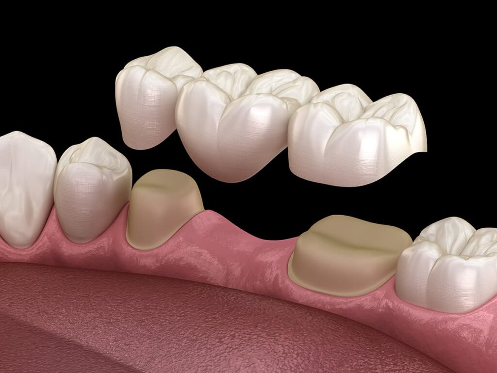 Dental implant compared with a traditional dental bridge
