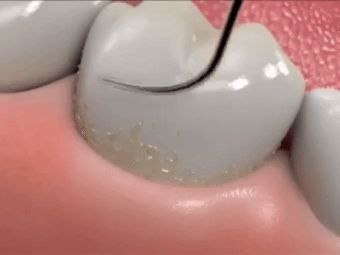 Regular dental cleaning compared with periodontal deep cleaning below the gumline