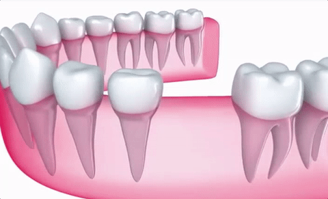 Dental implant and crown replacing a missing tooth in Newport Beach