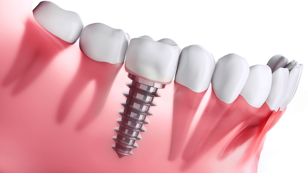 Dental implant fixture abutment and implant crown