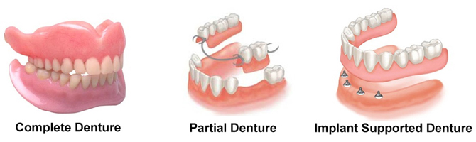 Complete partial and implant-supported dentures in Newport Beach