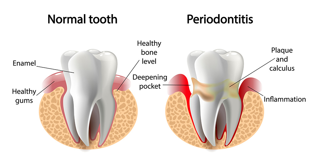 Healthy gums compared with periodontitis and bone loss
