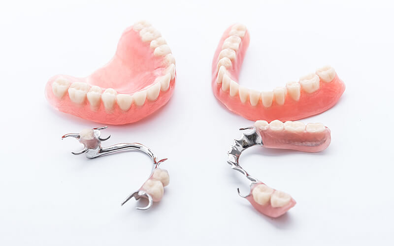 Conventional removable partial denture with metal framework