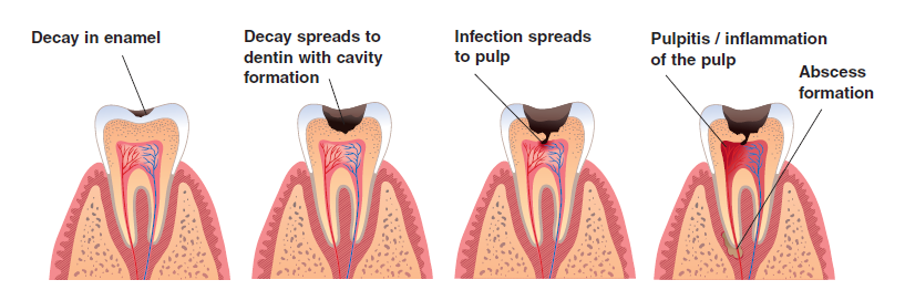Progression of tooth decay from small cavity to infected dental pulp