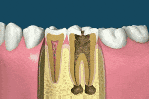 Root canal treatment and restoration of an infected tooth