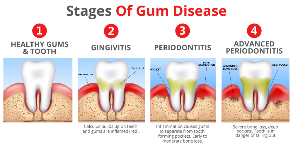 Stages of gum disease from gingivitis to periodontitis