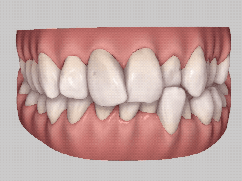 Clear aligner orthodontic treatment showing gradual tooth movement