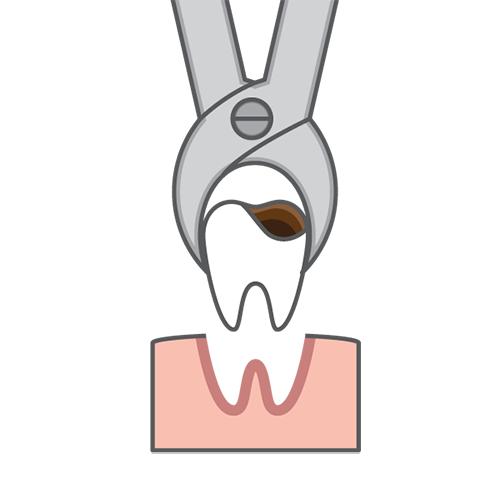 Tooth extraction in Newport Beach for a damaged tooth