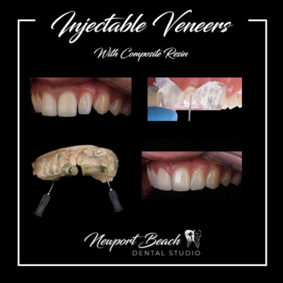Injectable composite veneers by Dr. Tai Ha in Newport Beach