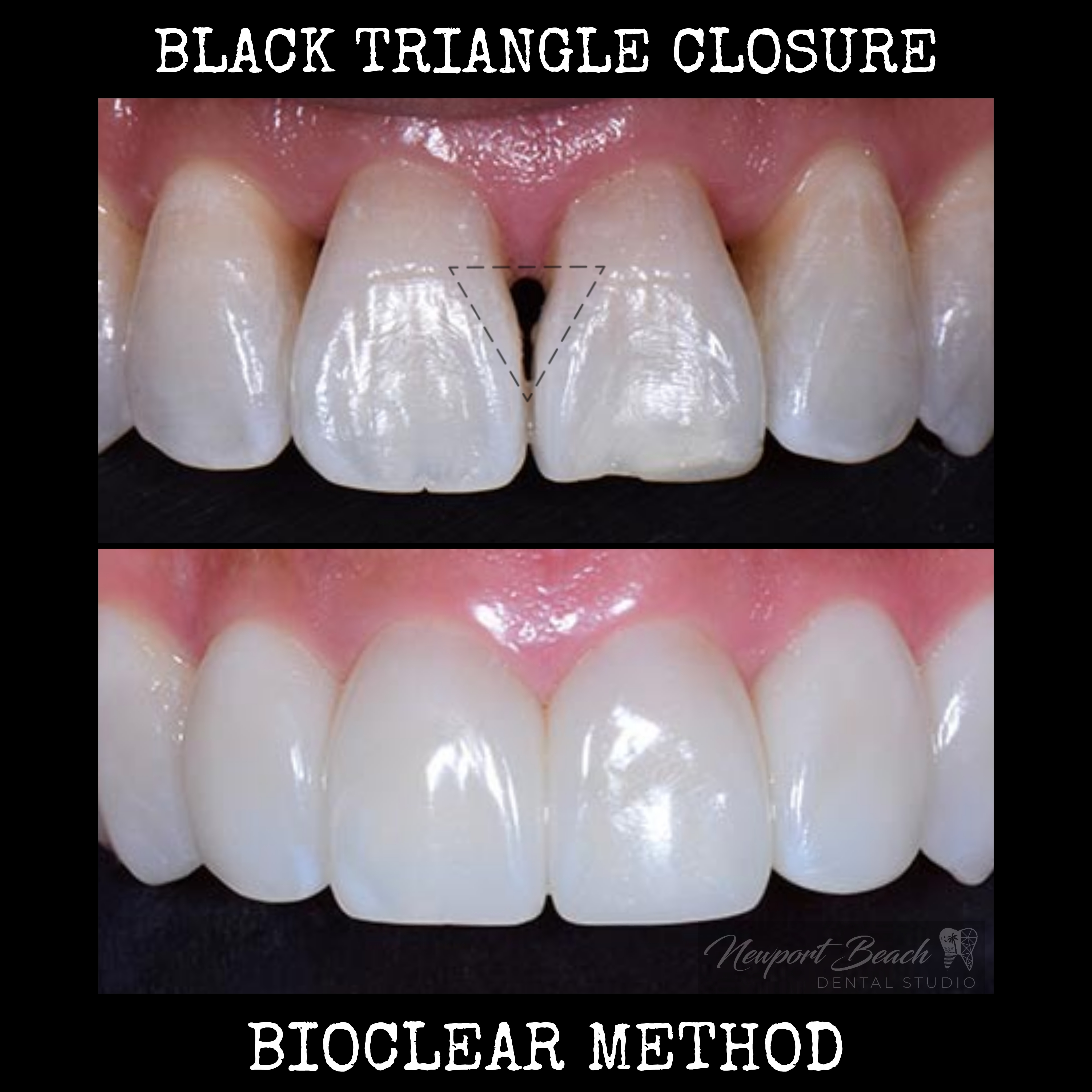 Black triangle treatment in Newport Beach between front teeth