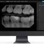 AI-assisted dental X-ray analysis at Newport Beach Dental Studio