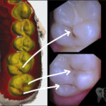 TRIOS digital intraoral scanning at Newport Beach Dental Studio