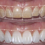 Digital Smile Design planning at Newport Beach Dental Studio