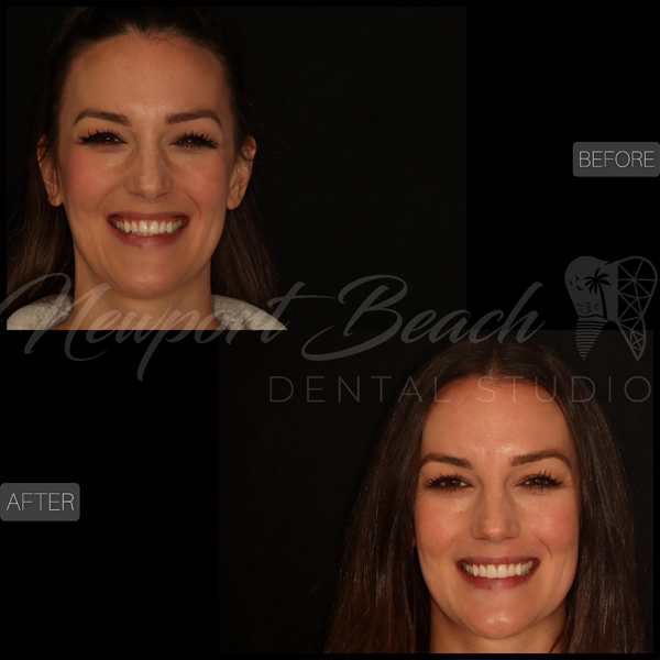 Injectable Dental Veneers Newport Beach