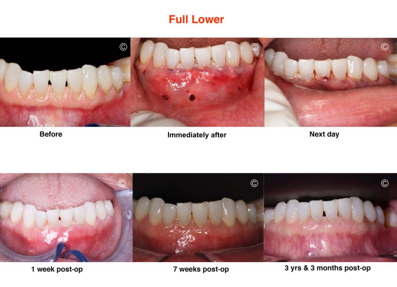 Lower teeth Pinhole gum recession treatment before and after