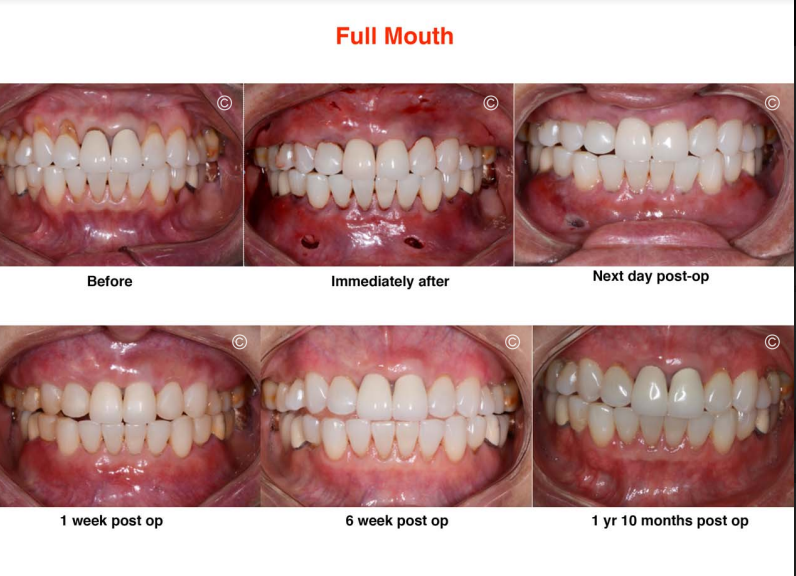Pinhole gum recession treatment before and after in Newport Beach