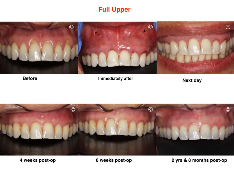 Upper teeth Pinhole gum rejuvenation before and after