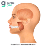 Masseter muscle pain referral pattern for TMJ Botox Newport Beach treatment