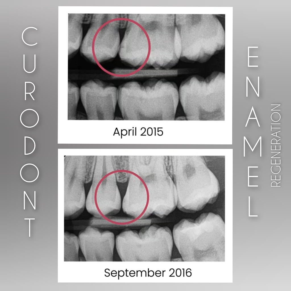 Curodont guided enamel remineralization for early cavities