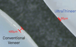 UltraThineer ultra-thin zirconia veneers in Newport Beach