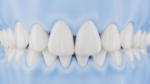 UltraThineer veneer treatment for selected black triangle spaces