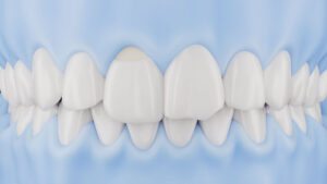 UltraThineer veneers for selected chipped and worn teeth