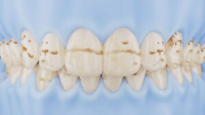UltraThineer veneers for enamel discoloration and fluorosis