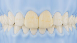 UltraThineer veneers for selected enamel hypoplasia