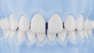 UltraThineer veneers for selected gaps between teeth