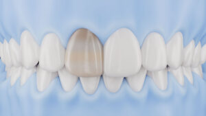 Cosmetic treatment for dark non-vital tooth