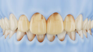 UltraThineer veneers for tooth discoloration