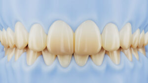 UltraThineer veneers for tetracycline stained teeth