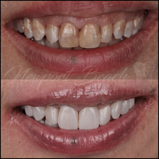 UltraThineer veneer cosmetic dentistry case