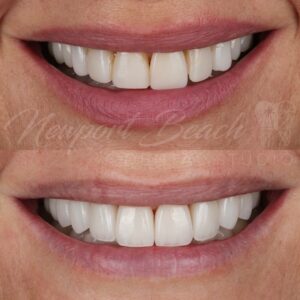Premium Ceramic Veneers