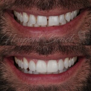 Premium Ceramic Veneers