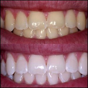 KöR Whitening cosmetic dentistry result at Newport Beach Dental Studio