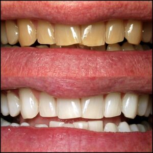 Professional teeth whitening before and after at Newport Beach Dental Studio