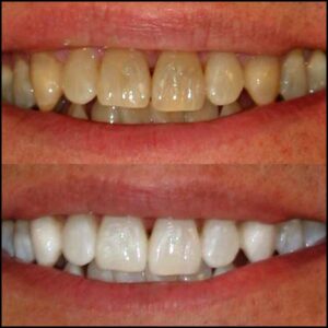 Natural teeth whitening result using KöR Whitening