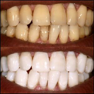 Before and after KöR whitening treatment in Newport Beach