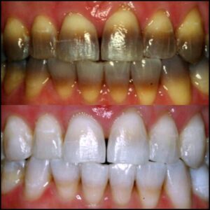 KöR teeth whitening before and after result in Newport Beach