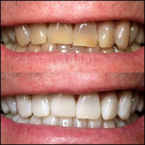 KöR professional whitening result by Dr. Tai Ha