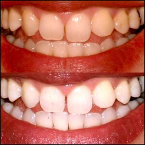 Professional whitening transformation at Newport Beach Dental Studio