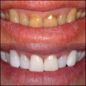 KöR teeth bleaching before and after in Newport Beach California