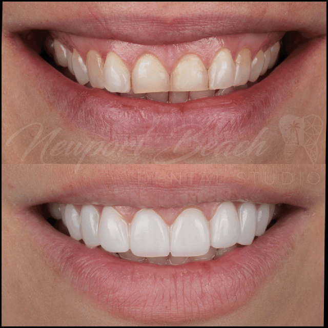 UltraThineer zirconia veneer smile transformation