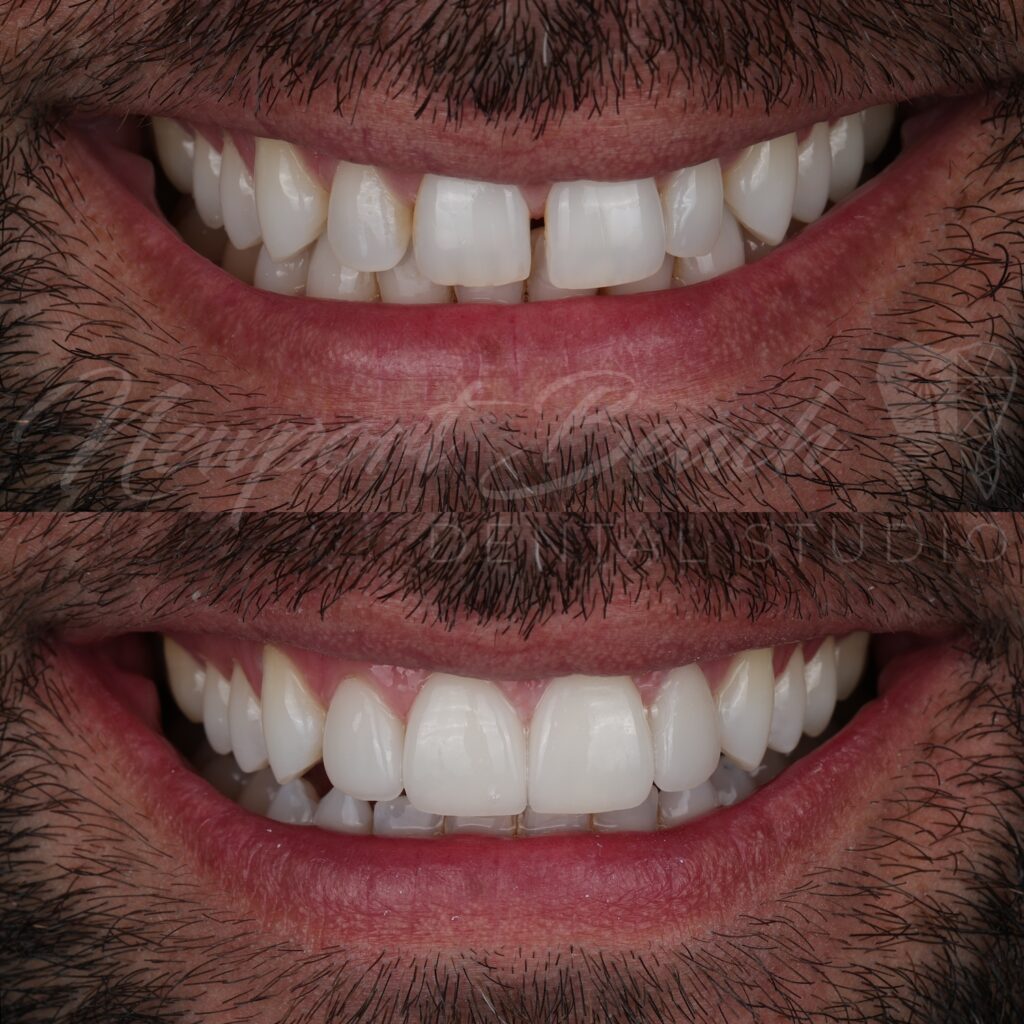 Porcelain Veneers Tai Ha DDS
