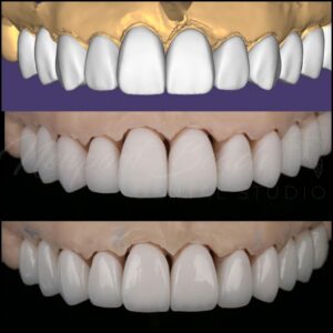 Dr. Tai Ha planning a digital smile design in Newport Beach