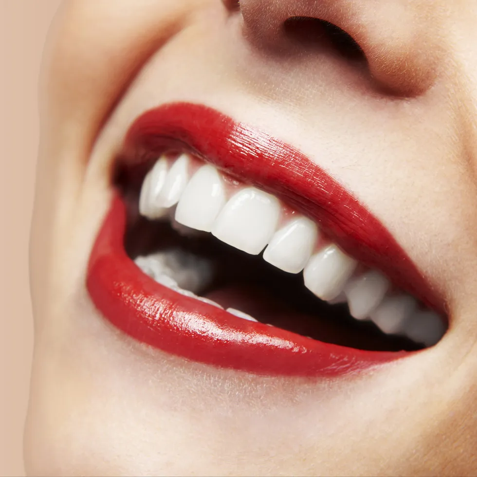 Dental Veneers