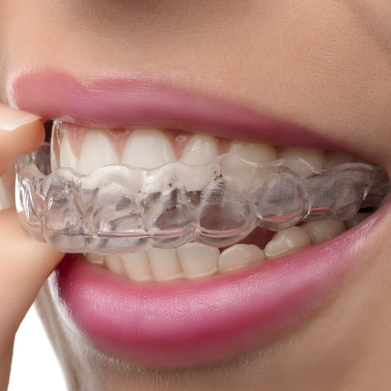 Clear Aligners