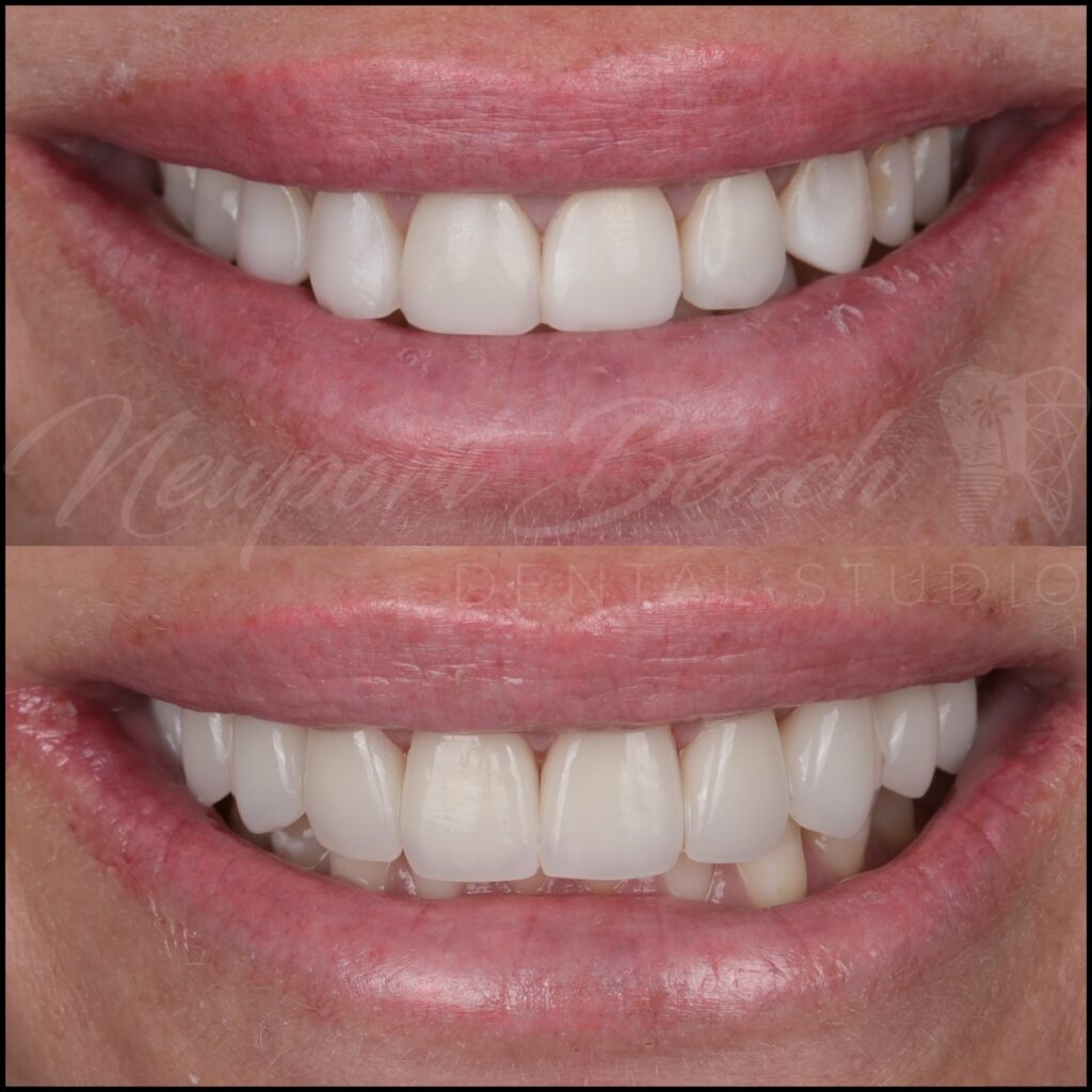 Replacing 10 Old Zirconia Veneers With Natural Layered E.max Veneers