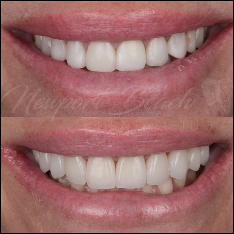 Before and after replacement of 10 aging zirconia veneers with layered E.max BL4 MT veneers improving tooth proportions, translucency and smile harmony at Newport Beach Dental Studio